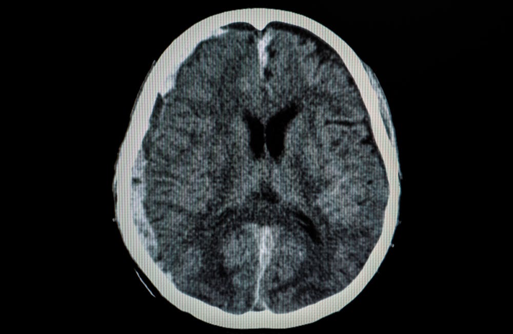 image of CT scan of a brain of a patient